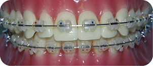 ceramic (clear) braces