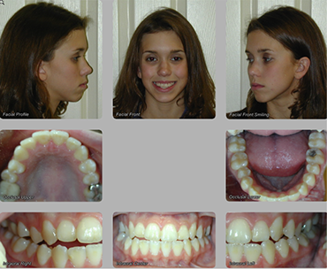 teeth extractions before