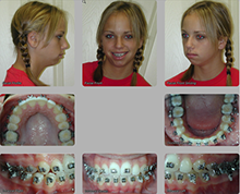 pre orthognathic surgery 