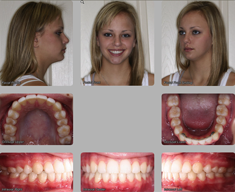 orthognathic surgery after