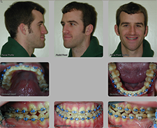 pre orthognathic surgery