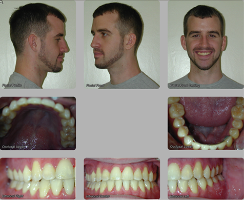 after orthognathic surgery