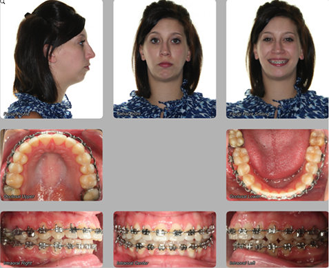 pre orthognathic surgery