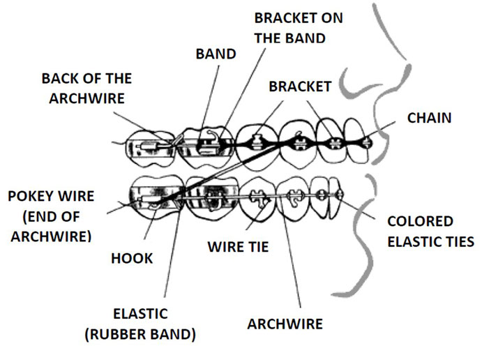 orthodontic parts, archwire, band, bracket, chain, colored elastic ties, wire tie