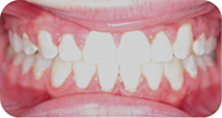 MIddleton Orthodontics, Ortho & Surgery, TADS
