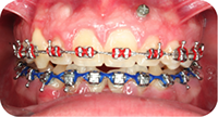 Middleton Orthodontics, Ortho & Surgery, TADS