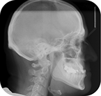 class III underbite adult central occlusion
