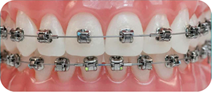 Types of Braces  Gehring Orthodontics